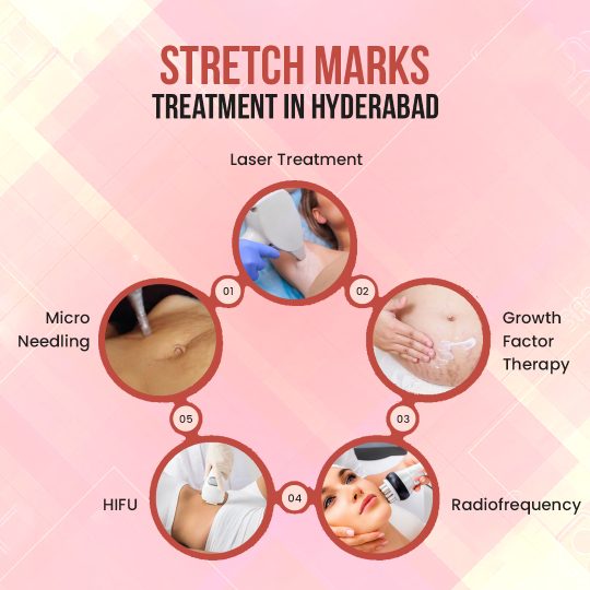 Stretch Marks Treatment in Hyderabad - Treatments options available: Laser Treatment, Micro Needling, HIFU, Radiofrequency